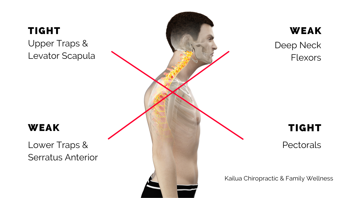 Upper Cross Syndrome: The Importance of Posture Regarding Structure and Function